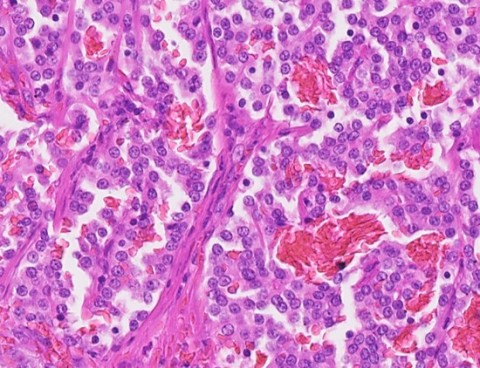 thyroid-image011